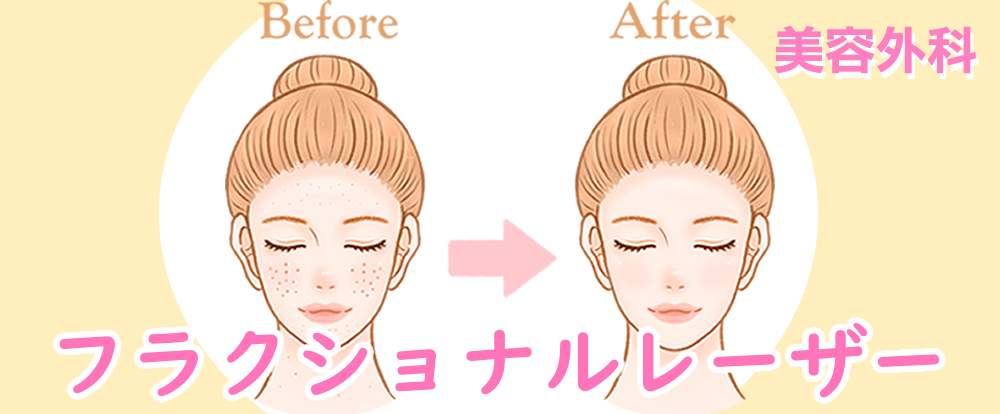 フラクショナルレーザー