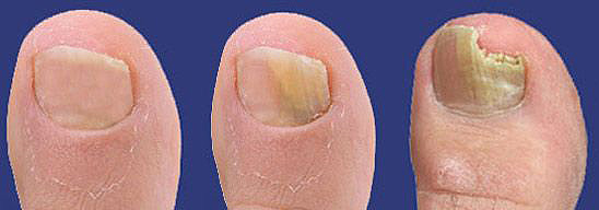 日数経過に伴う爪白癬の感染が広がっていく[写真]