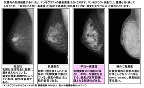 4つの乳房構成[図]