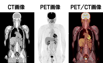 CT画像・PET画像・PET-CT画像の比較[図]