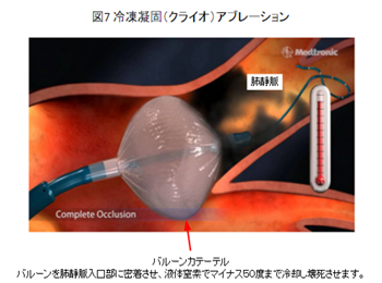 冷却凝固（クライオ）アブレーション