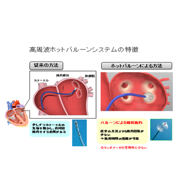 高周波ホットバルーンシステムの特徴