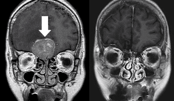 脳腫瘍[写真]