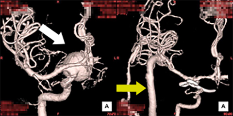 開頭脳動脈瘤クリッピング術[写真]