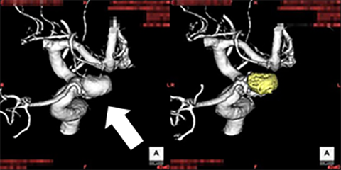  血管内脳動脈瘤塞栓術[写真]