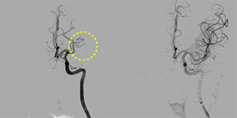 血管内血栓回収療法[写真]