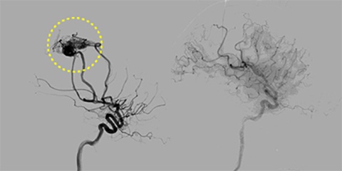 脳動静脈奇形[写真]